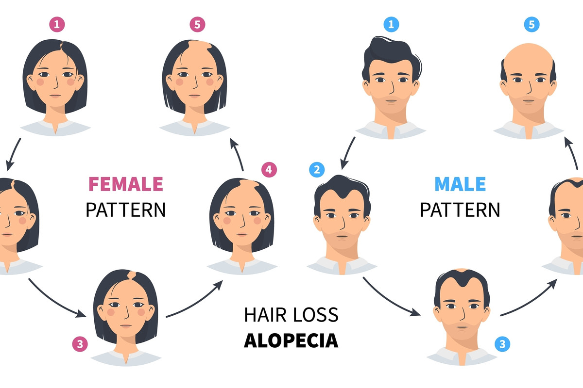 7 Causes of Hair Loss, and Their Treatment