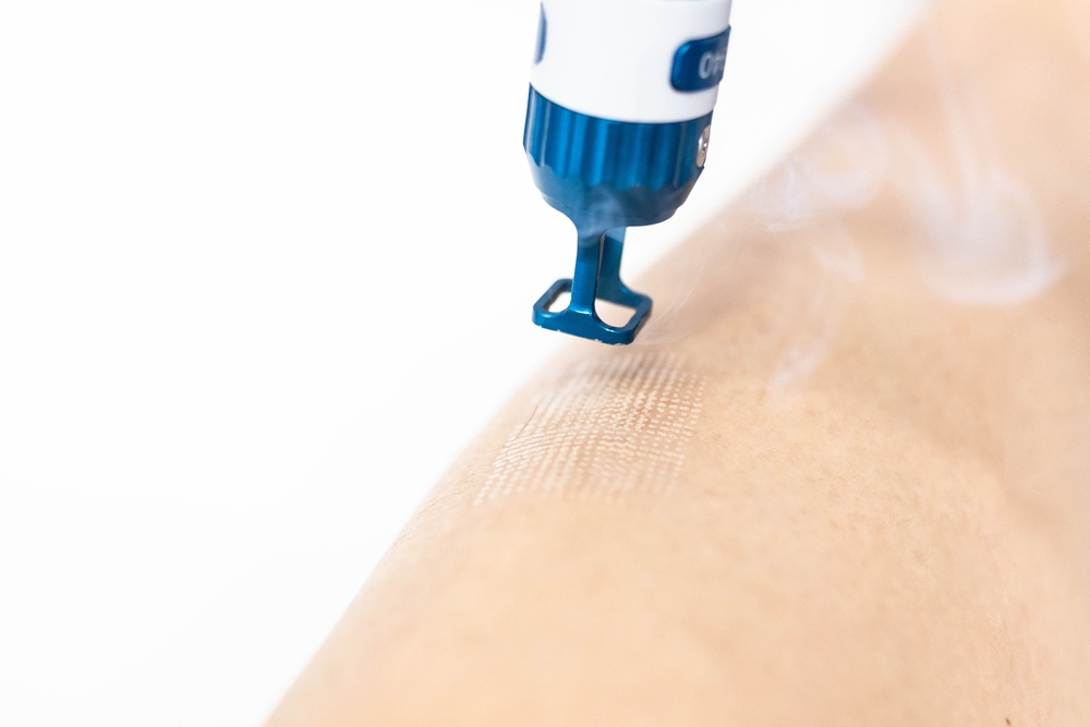 IPixel Laser Resurfacing | Dr Hala Medical Aesthetics London
